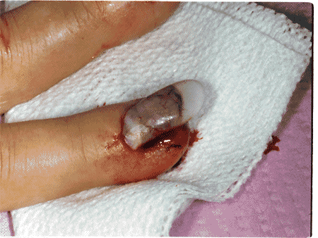 Acrylic nail warning